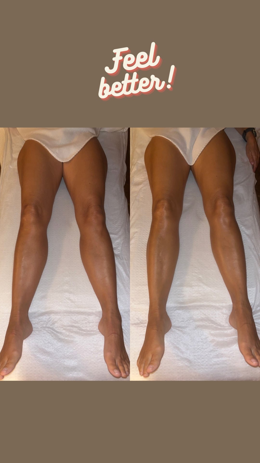 Avant et après drainage : jambes affinées